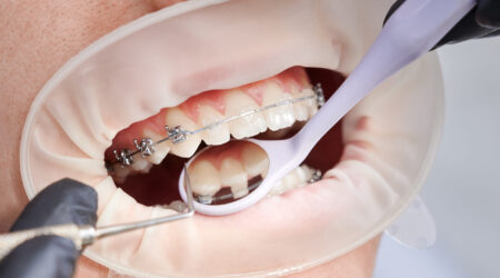 Close up of orthodontist placing orthodontic brackets on patient teeth. Person with cheek retractor and metal braces on teeth having dental procedure in clinic. Concept of orthodontic treatment.